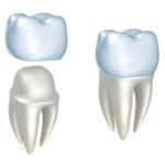 What You Need to Know About Dental Crowns